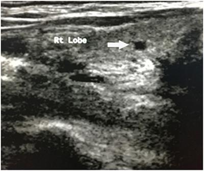 Amyotrophic Lateral Sclerosis and Primary Biliary Cirrhosis Overlap Syndrome: Two Cases Report